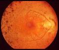 Imagen de ojo con Retinosis Pigmentaria.