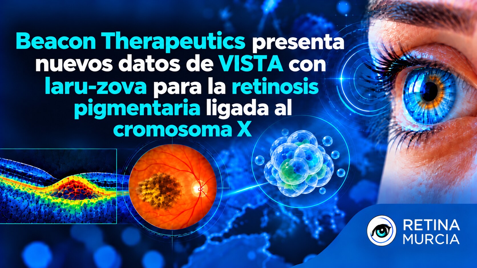 Beacon Therapeutics presenta nuevos datos de VISTA con laru-zova para la retinosis pigmentaria ligada al cromosoma X